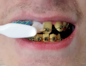 nicotine stains on teeth