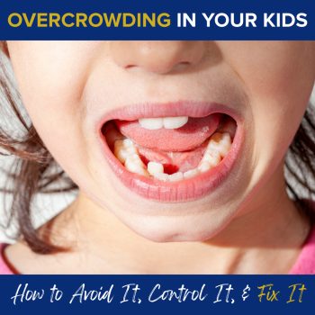 Lincoln & Grass Valley pediatric dentist, Dr. Michelle Kucera at Caring Tree Children's Dentistry, discusses overcrowding- how to spot it, control it, and fix it. Read on to learn what to look out for and the treatment options available to help your child achieve a straighter, healthier smile.
