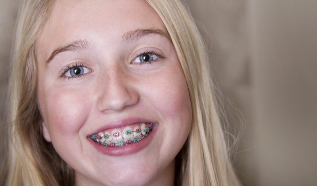 Does My Child Need Braces? (featured image)