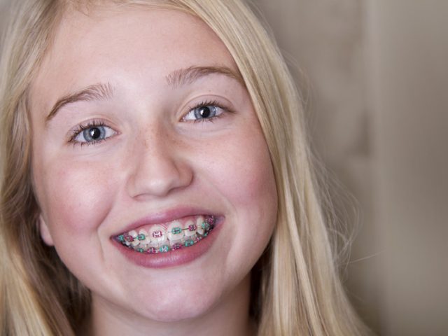 Does My Child Need Braces? (featured image)