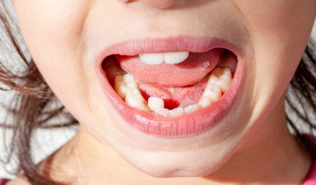 Overcrowding in Your Kids: How to Avoid It, Control It, and Fix It (featured image)