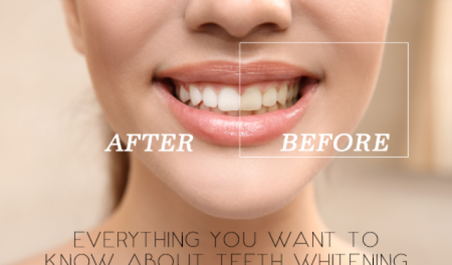 Everything You Want to Know About Teeth Whitening (featured image)